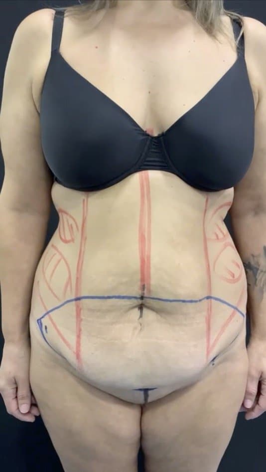 Abdominoplastia - AA Clinic