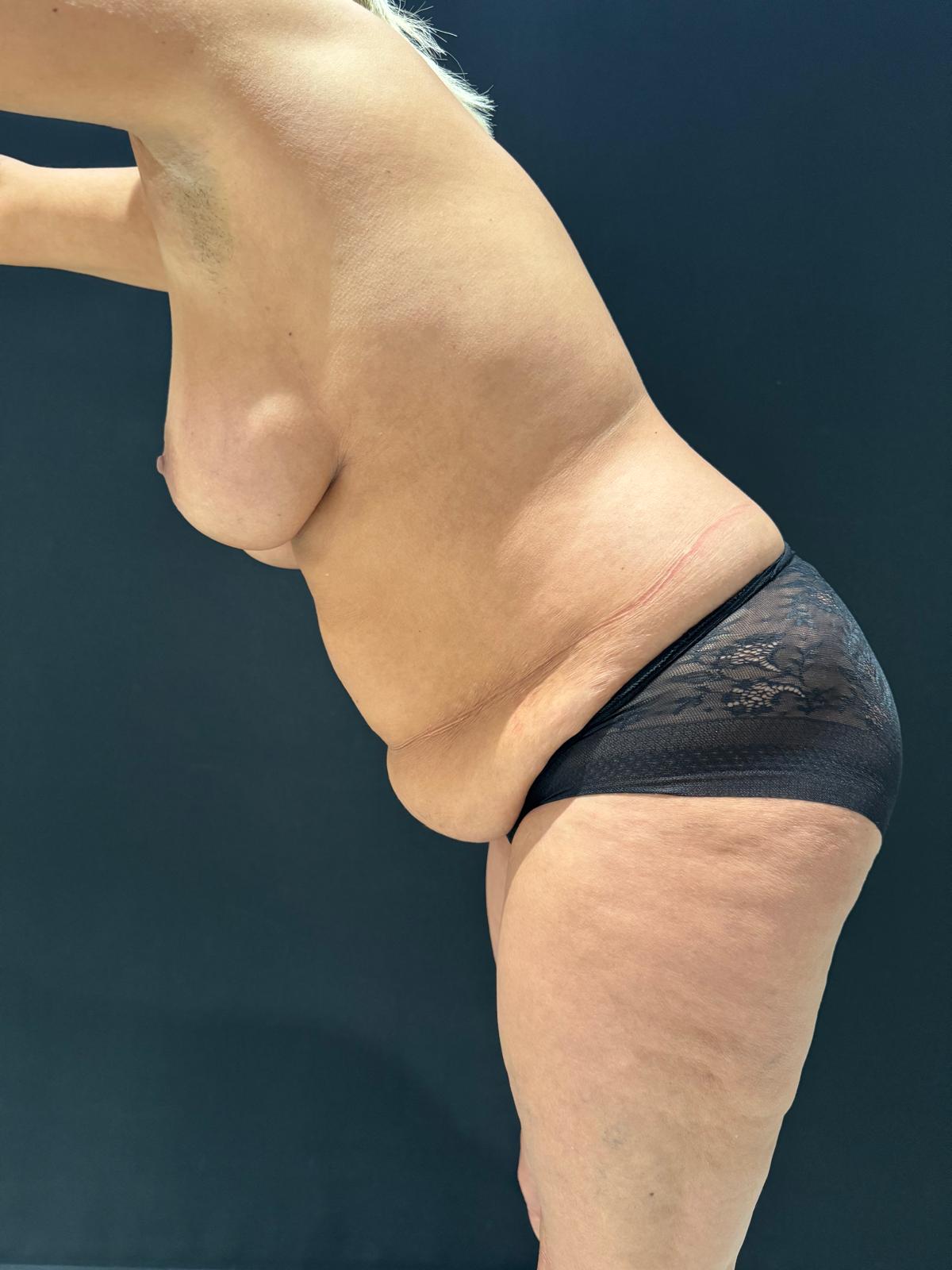 abdominoplastia+vaser-antes-y-despues-1