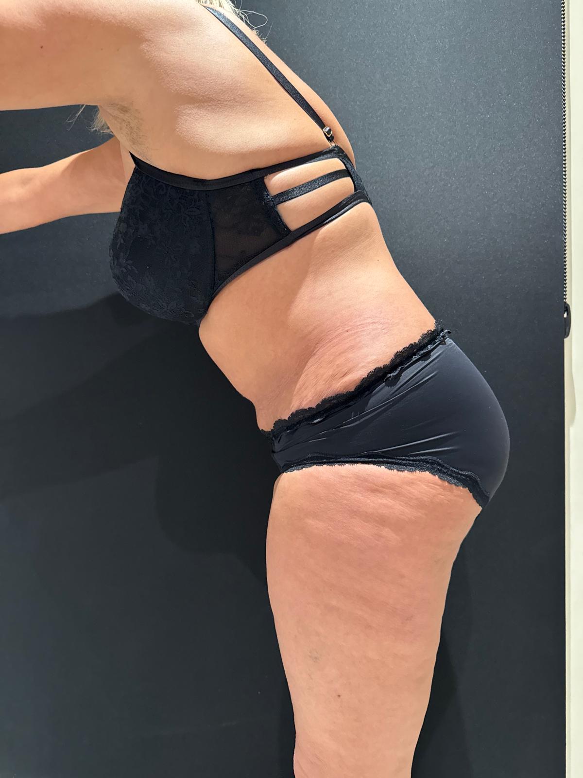 abdominoplastia+vaser-antes-y-despues-2