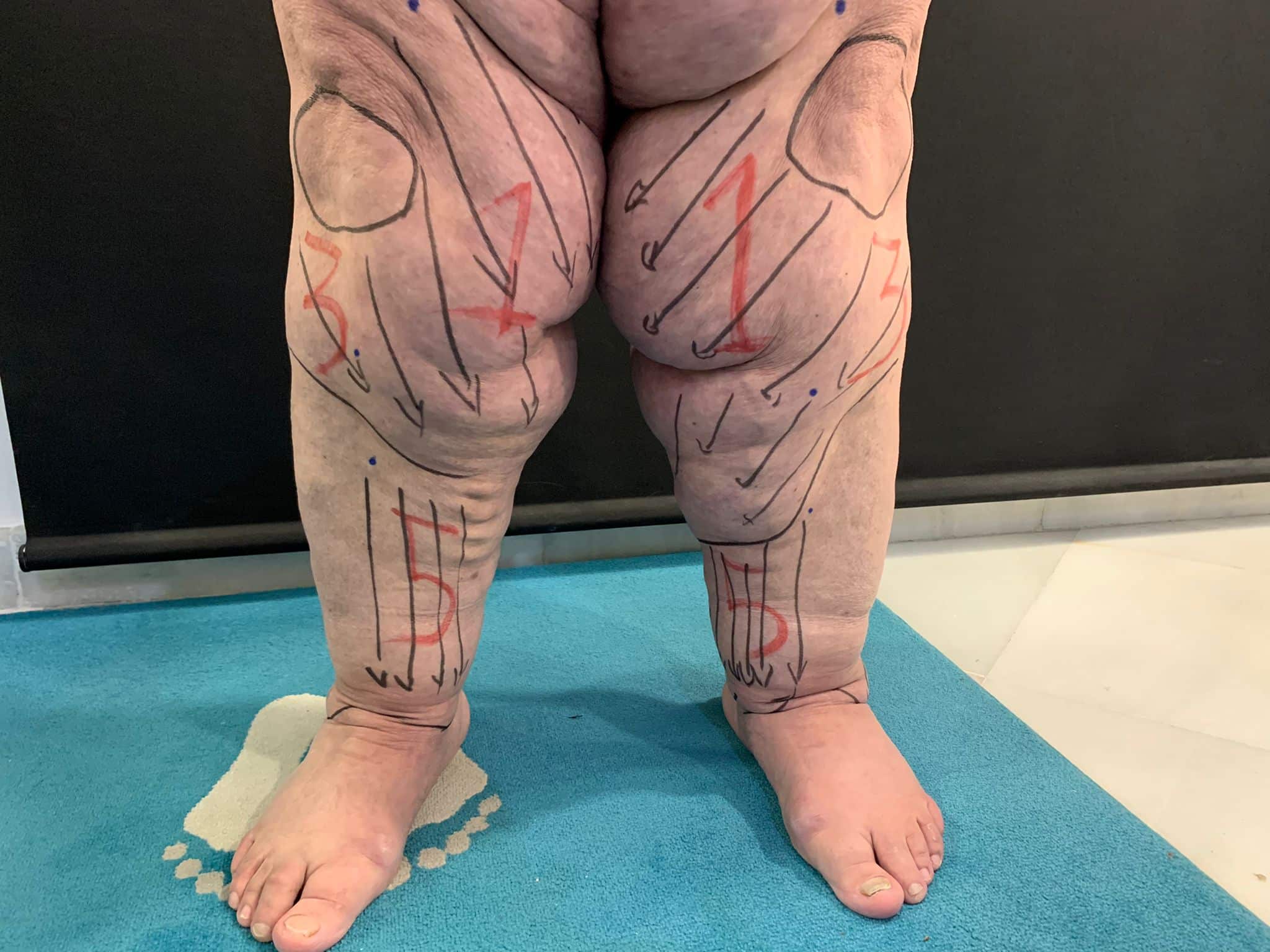 mujer con lipedema en piernas