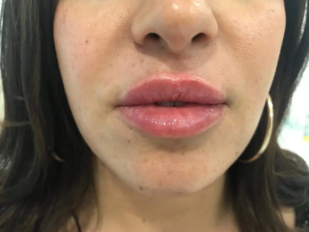 aa-clinic-antes-y-despues-aumeto-labios-13