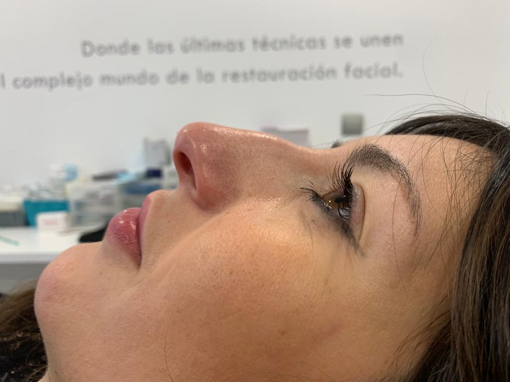 aa-clinic-antes-y-despues-aumeto-labios-33