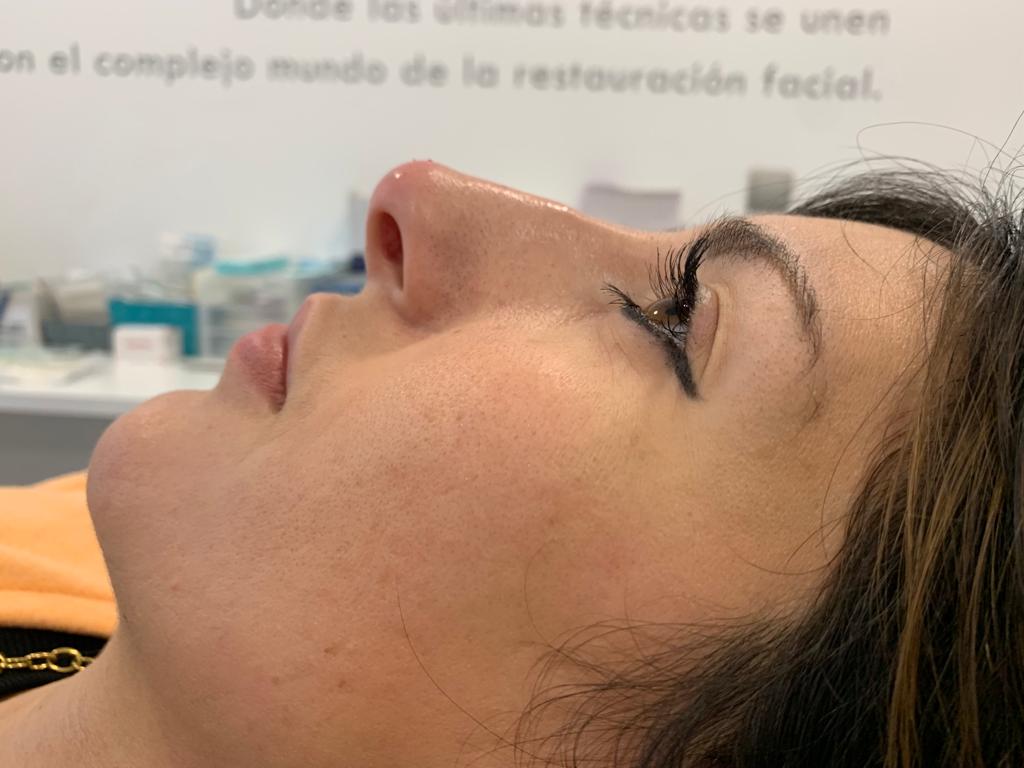 aa-clinic-antes-y-despues-aumeto-labios-34