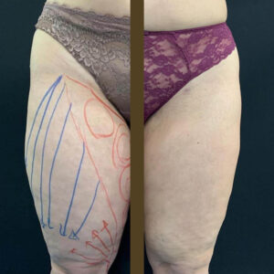 Antes y despues de piernas con lipedema