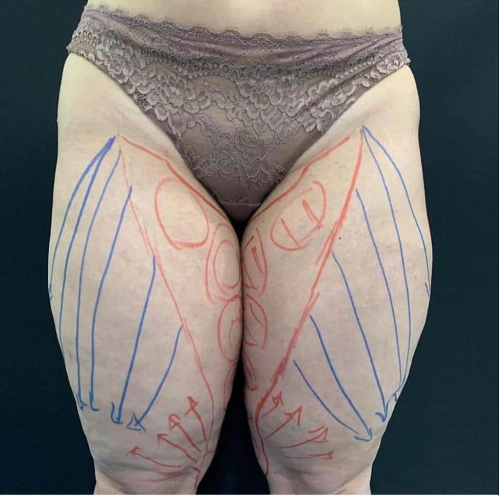 aaclinic-tratamiento-lipedema-antes-y-despues-1
