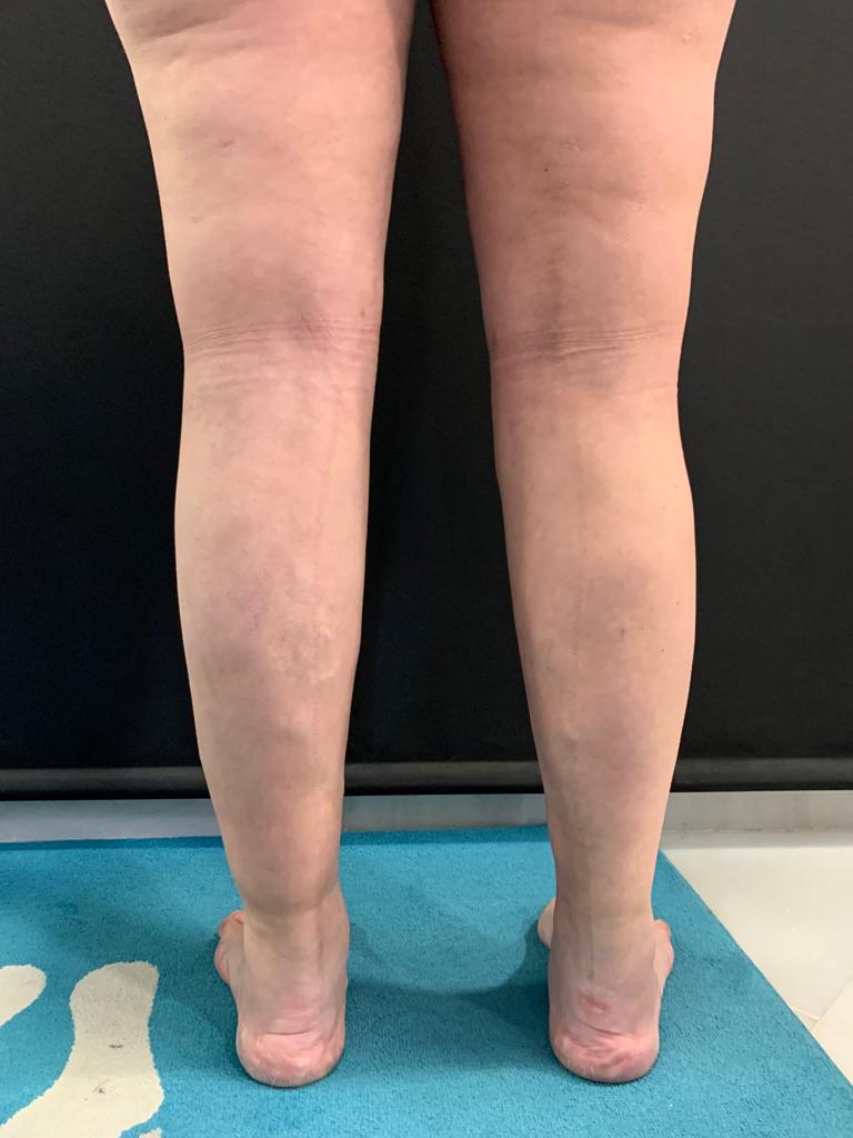 aaclinic-tratamiento-lipedema-antes-y-despues-10