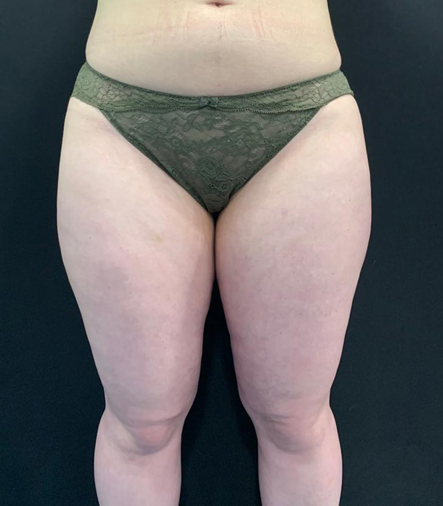 aaclinic-tratamiento-lipedema-antes-y-despues-11