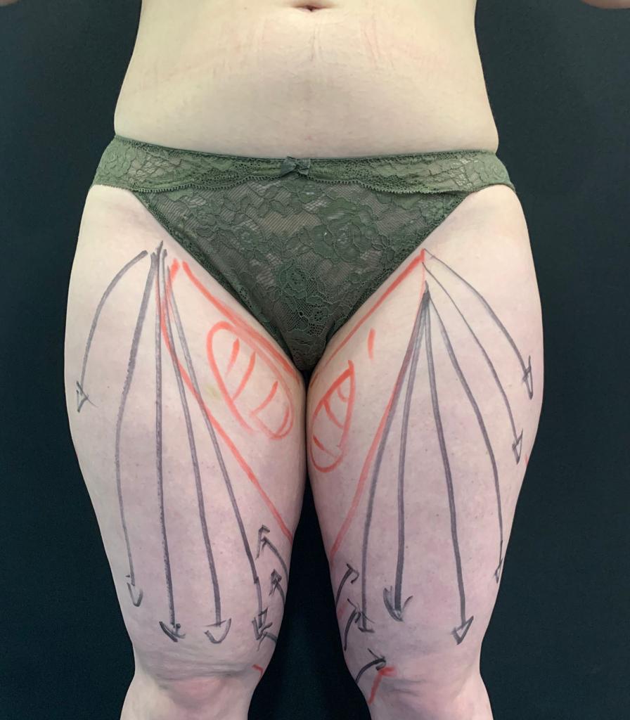 aaclinic-tratamiento-lipedema-antes-y-despues-12