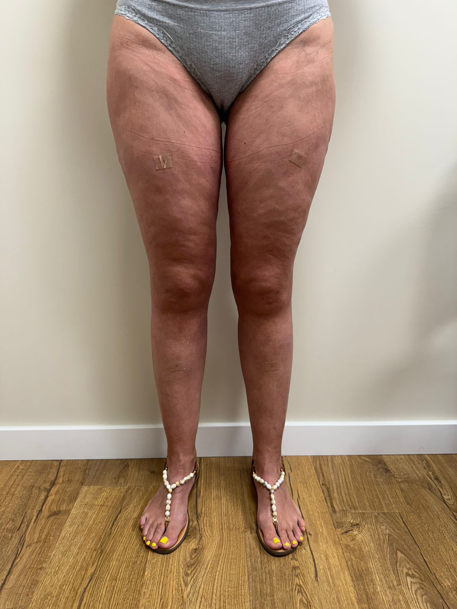 aaclinic-tratamiento-lipedema-antes-y-despues-13