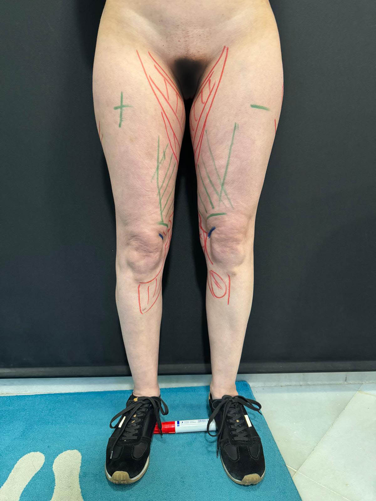 aaclinic-tratamiento-lipedema-antes-y-despues-17