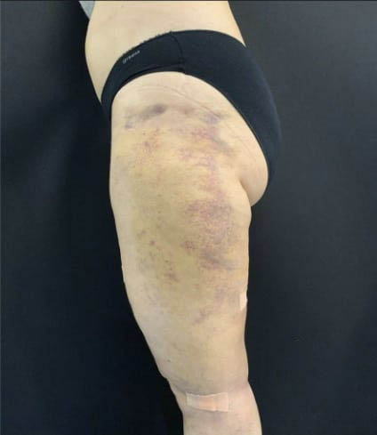 aaclinic-tratamiento-lipedema-antes-y-despues-3