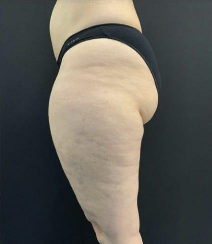 aaclinic-tratamiento-lipedema-antes-y-despues-4