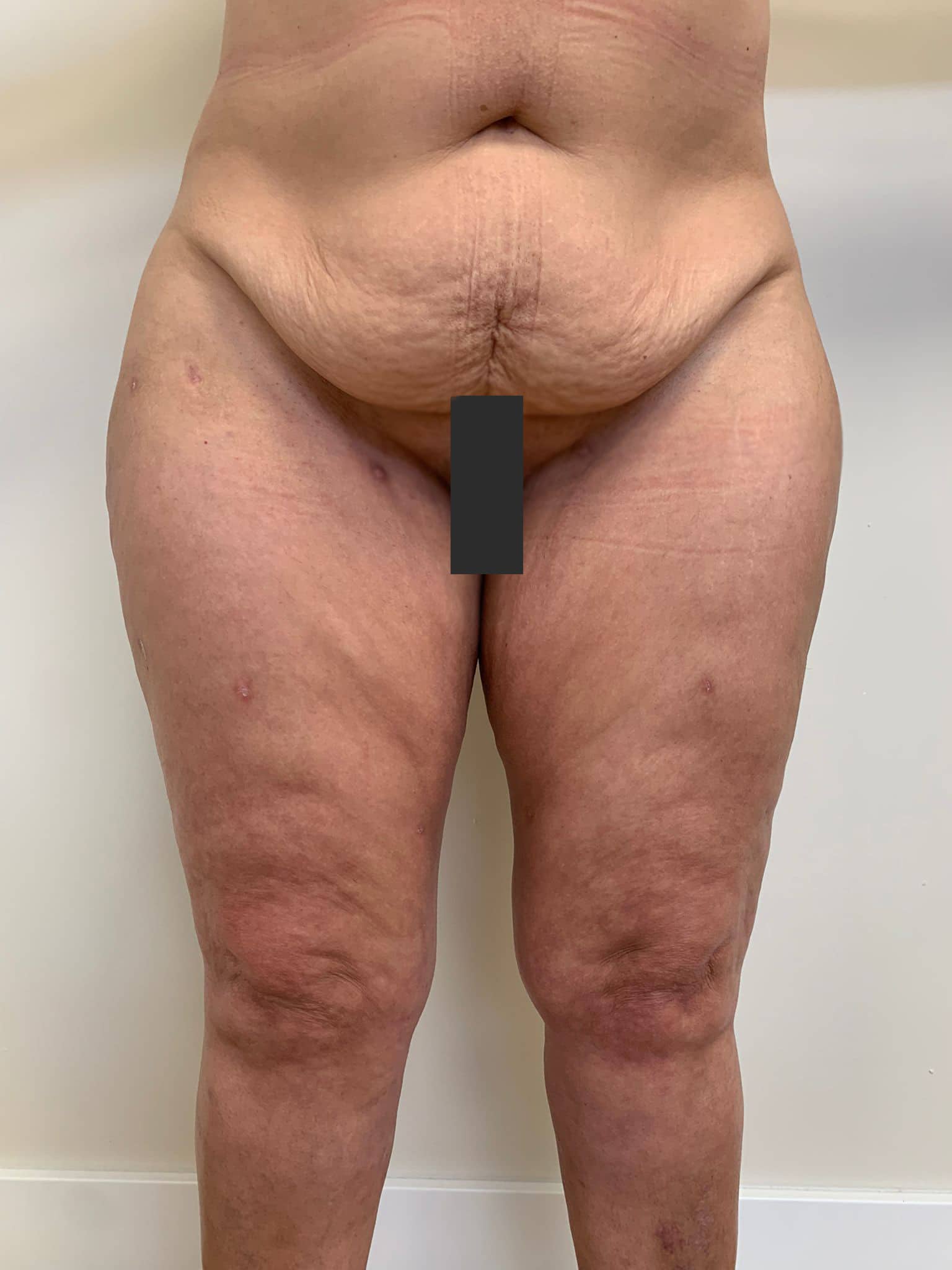 aaclinic-tratamiento-lipedema-antes-y-despues-6