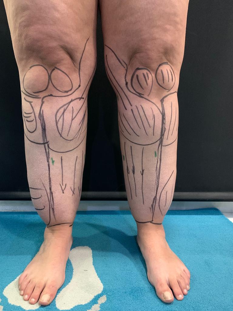 aaclinic-tratamiento-lipedema-antes-y-despues-7