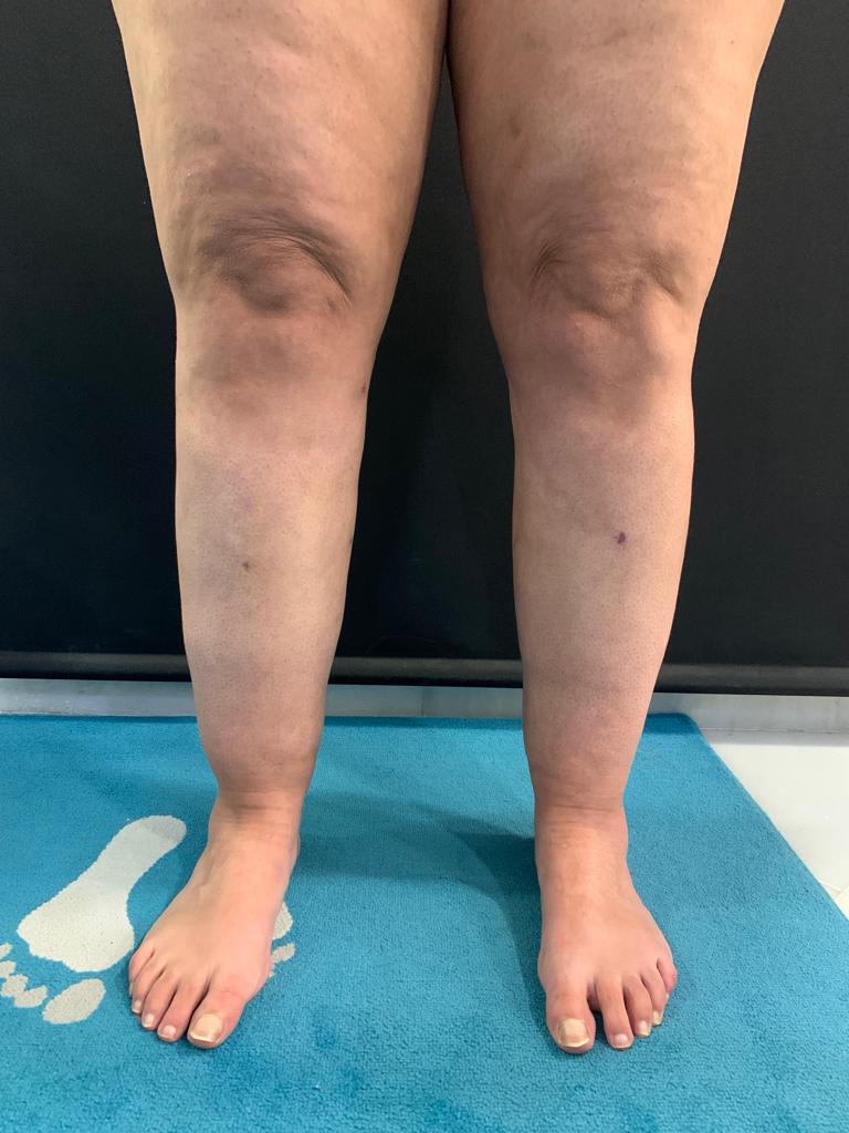 aaclinic-tratamiento-lipedema-antes-y-despues-8