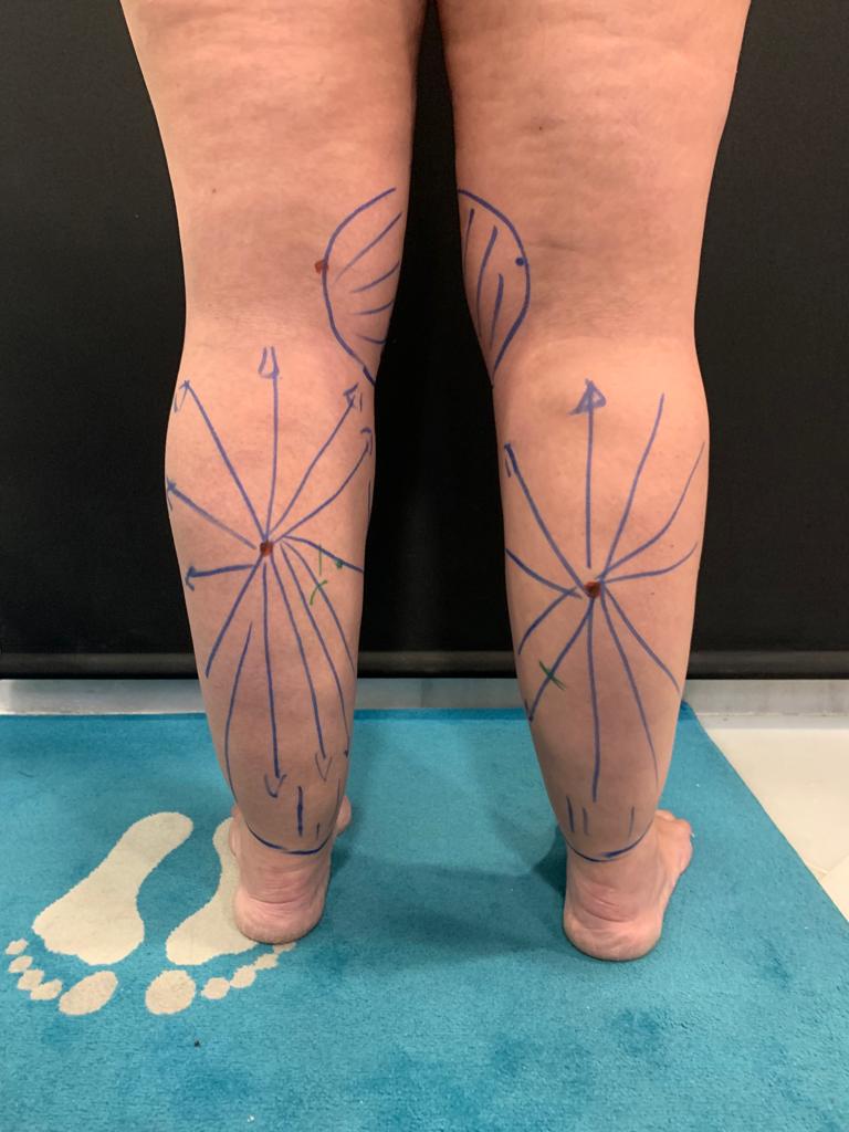 aaclinic-tratamiento-lipedema-antes-y-despues-9