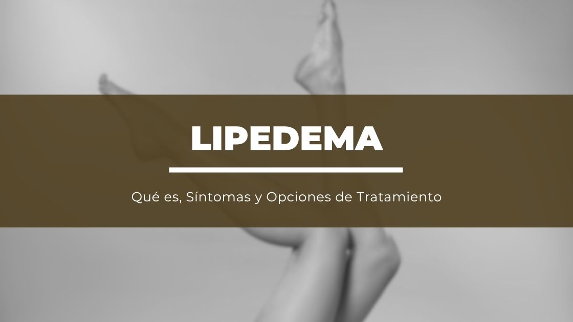Tratamiento de Lipedema: Qué es, Síntomas y Opciones de Tratamiento