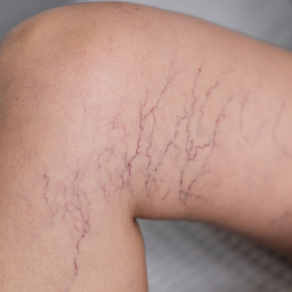 aaclinic cirugia vascular esclerosis aranas vasculares ourense