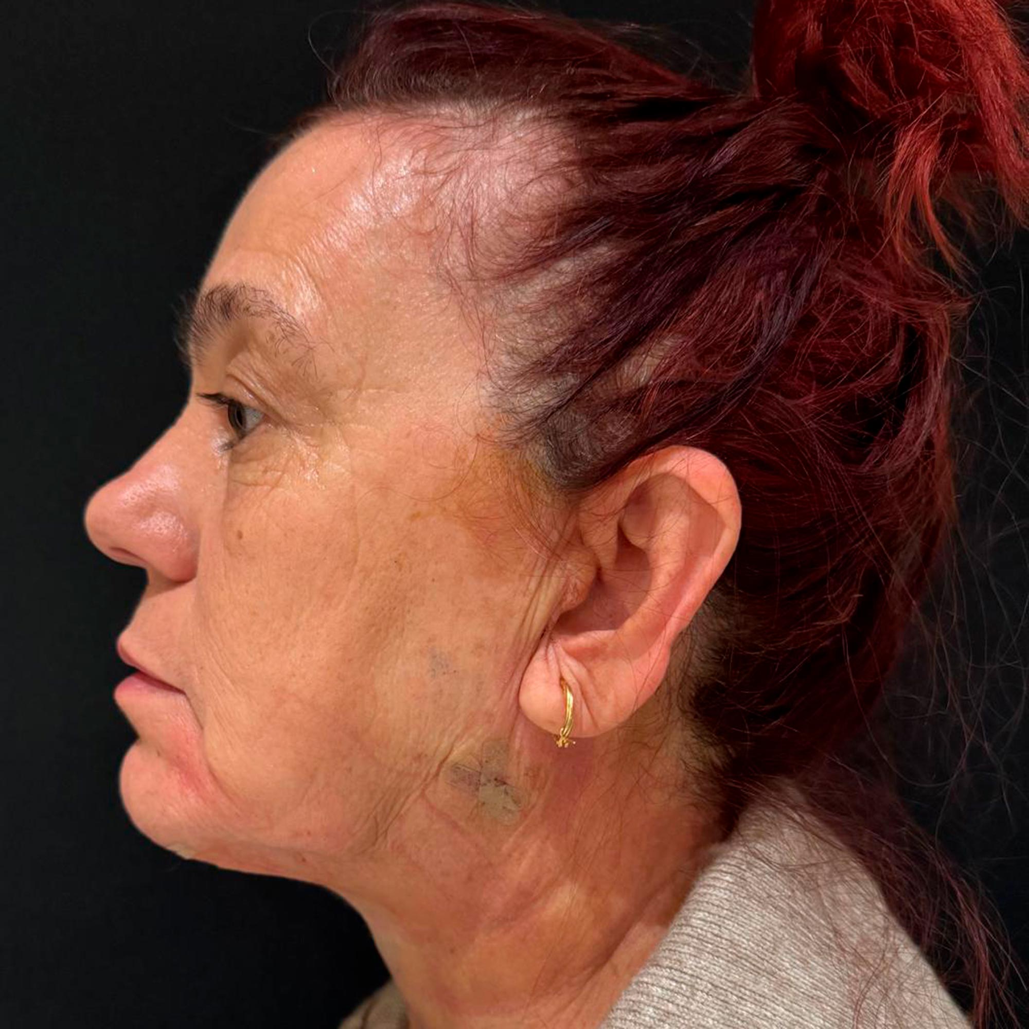 antes-y-despues-tratamiento-papada-endolifting-4